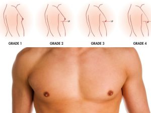 ژنیکوماستی یا کوچک کردن سینه مردان